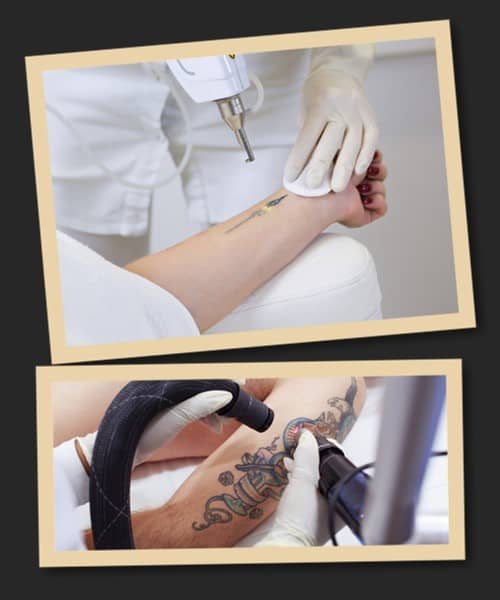 Ефективність процесу лазерного видалення тату