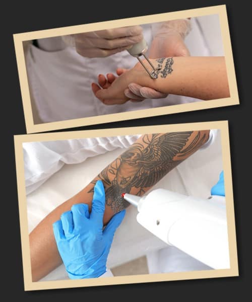 вивести татуювання лазером в Києві