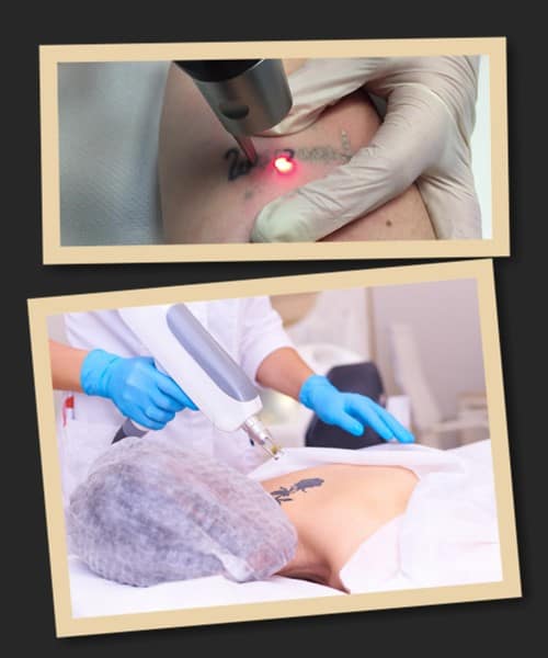 вивести татуювання лазером