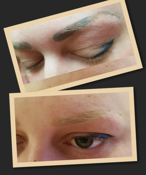 Як зробити видалення татуажу ефективнішим