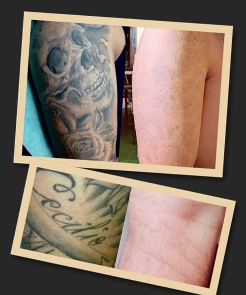 видалення великого тату