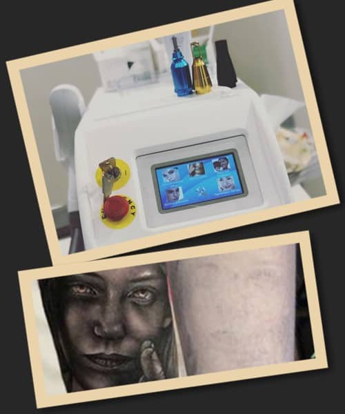 видалення великих татуювань лазером