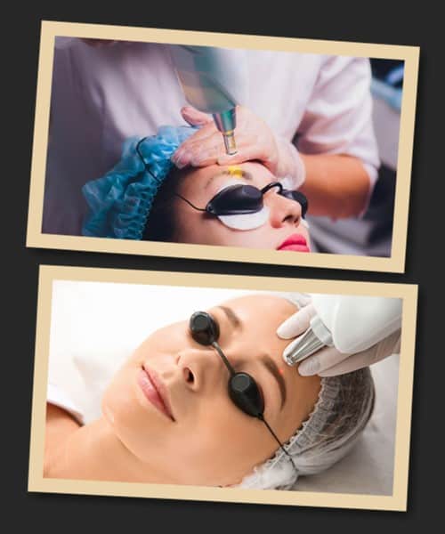 Лазерний метод видалення татуажу