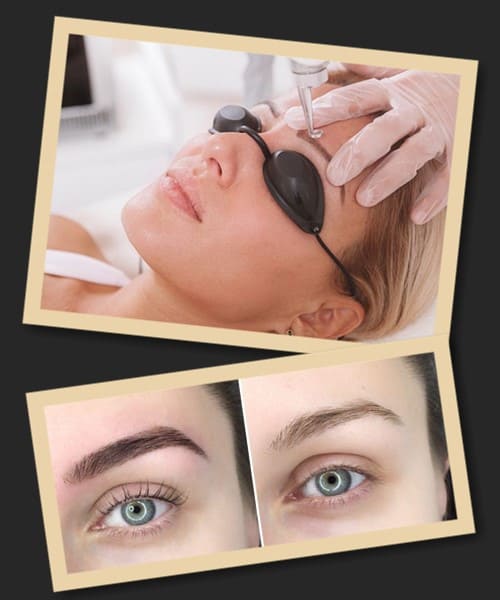 лазерна процедура видалення пудрових брів