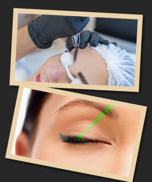 Видалення старого татуажу лазерним способом