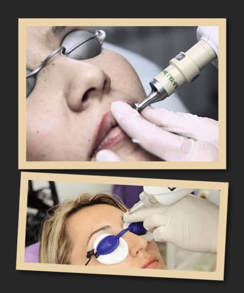 видалення старого татуажу на обличчі