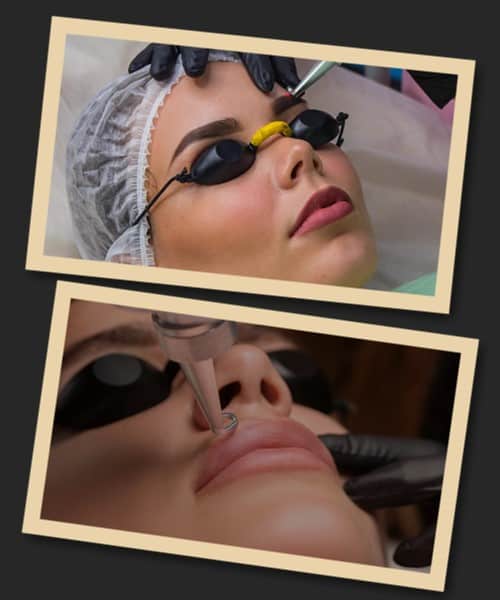 Лазерне видалення старого татуажу