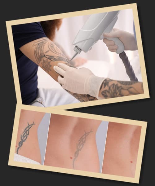 Видалення татуювання лазером: до та після