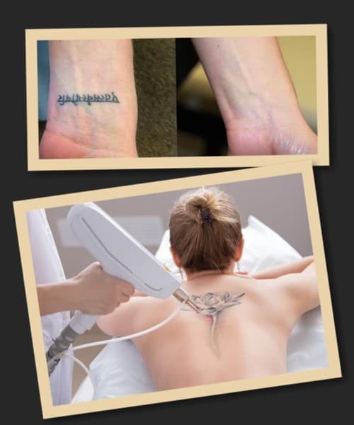 Лазерне видалення татуювань