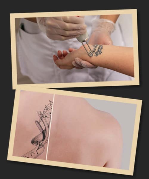 Ефективність процедури видалення тату лазером