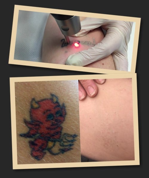 видалення татуювання лазером