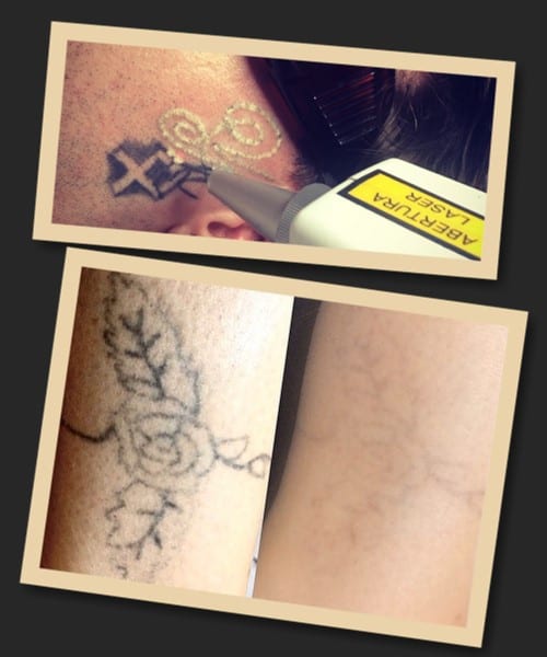 видалення тату лазером до та після процедури