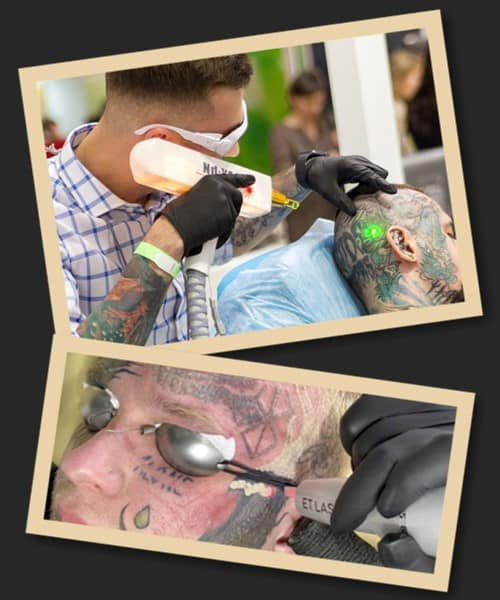 Особливості видалення татуювання з обличчя
