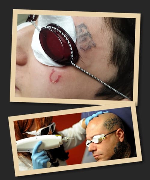 Видалення татуювань на обличчі