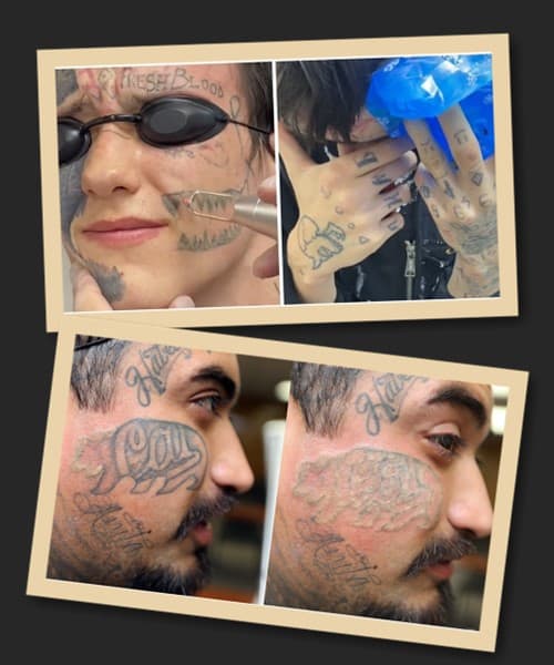 лазерне видалення тату на обличчі