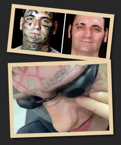 Видалення тату на обличчі лазером
