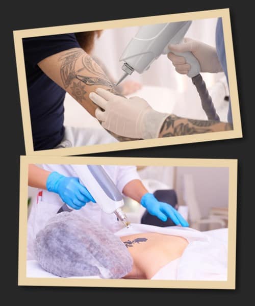 Видалення татуювань недорого