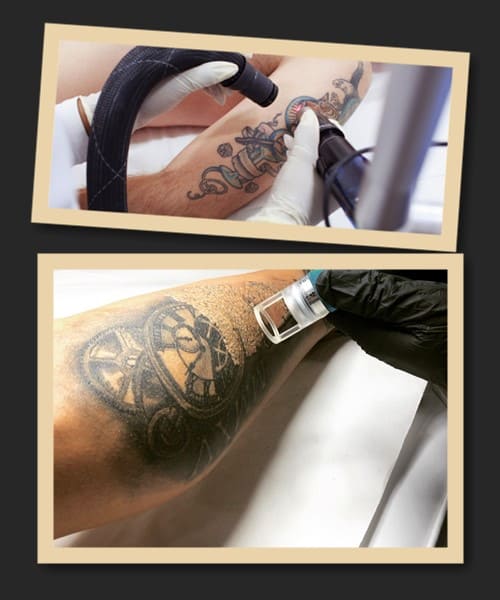 лазерне видалення тату