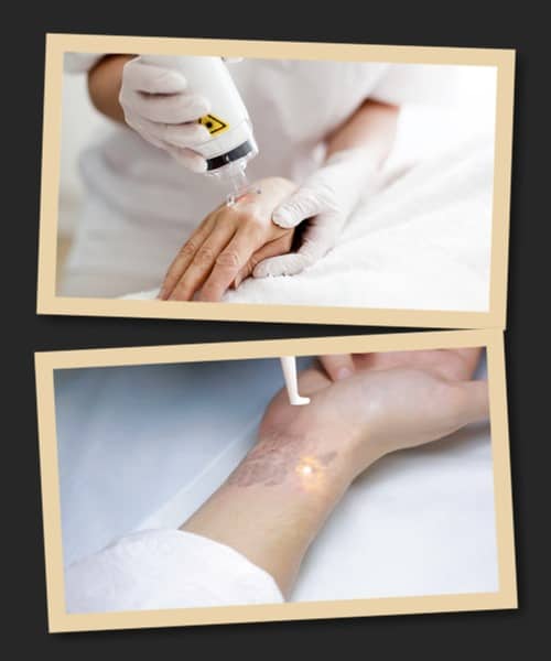 Переваги лазерної обробки тату