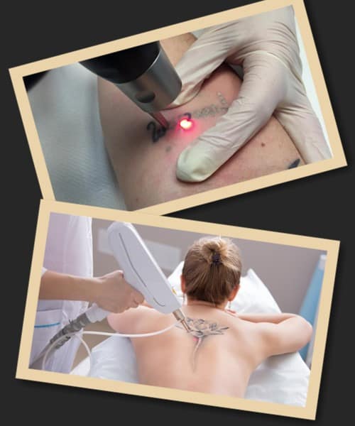 вартість видалення тату