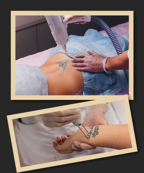 видалення татуювань лазером