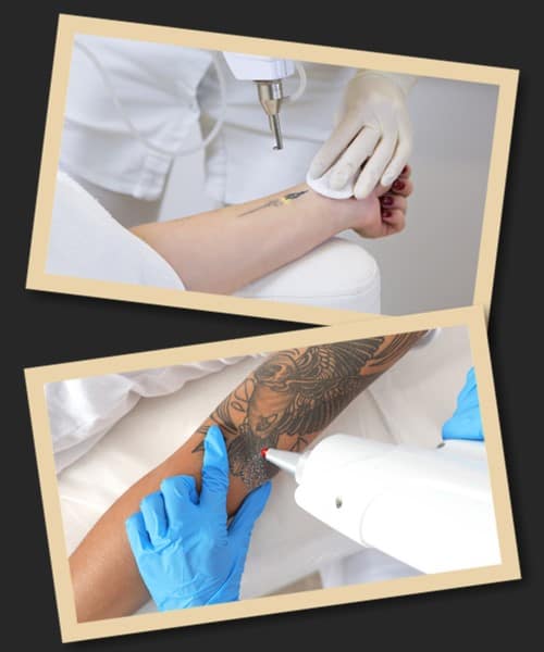 видалення татуювань лазером недорого в Києві