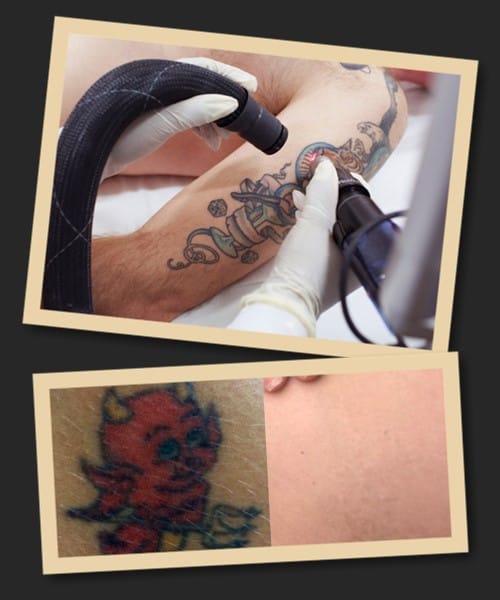 Видалення кольорового татуювання