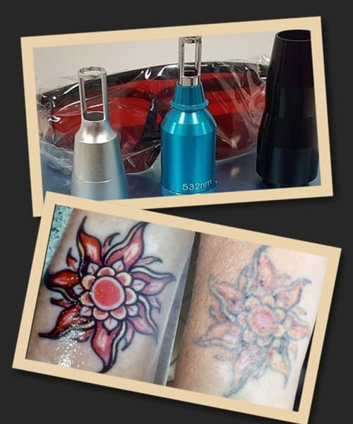 Видалення тату лазерним апаратом