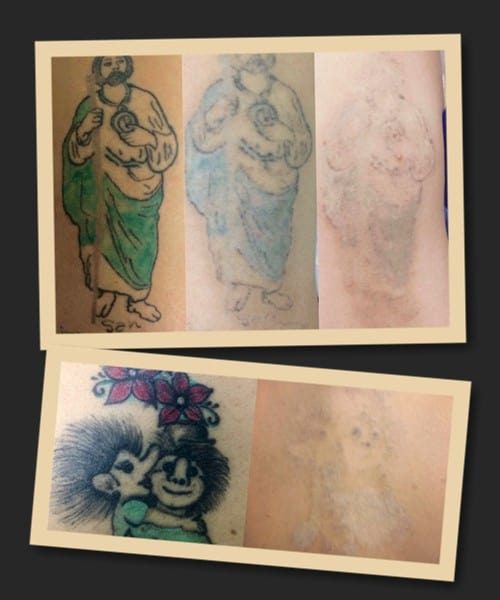 лазерне зведення кольорового татуювання у Києві