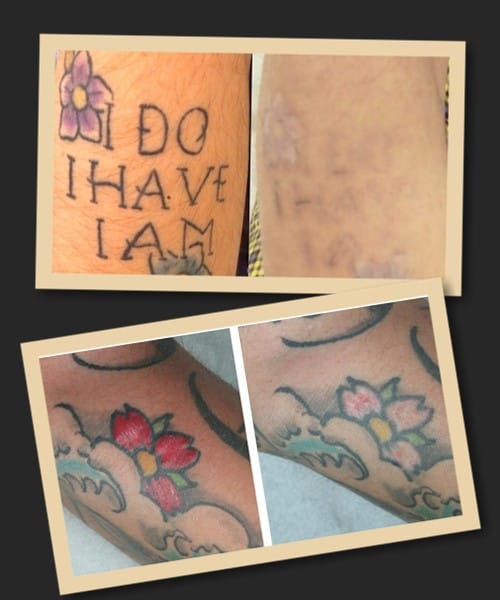 Ефективність зведення кольорових тату лазером