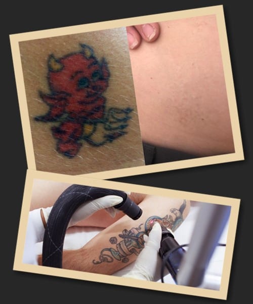 Видалення кольорових татуювань