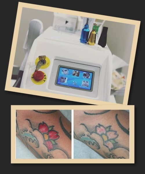 Особливості лазерного видалення тату