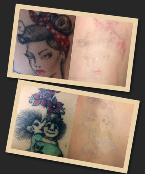 Ефективність лазерного методу при зведенні кольорових татуювань