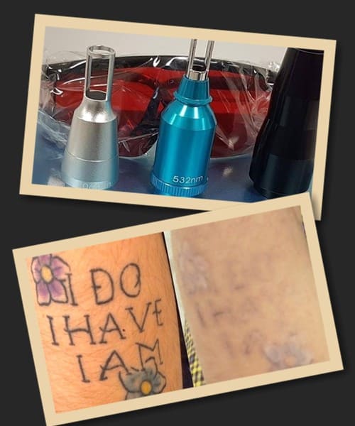 лазерне виведення татуювань