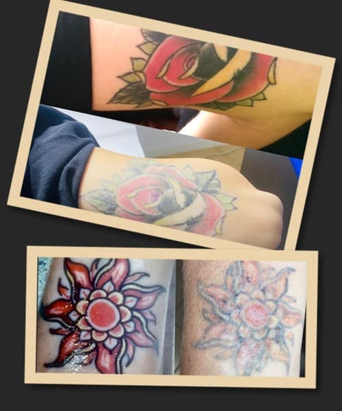 Видалення кольорових тату