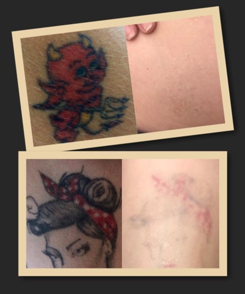 Видалення червоних татуювань