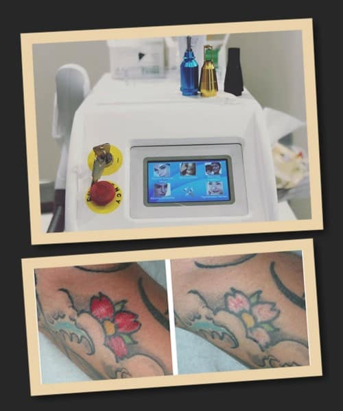 Лазерне видалення татуювання