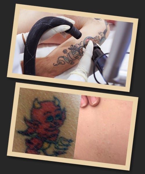 Видалення кольорових татуювань лазером