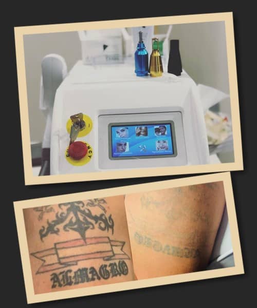 видалити тату лазером