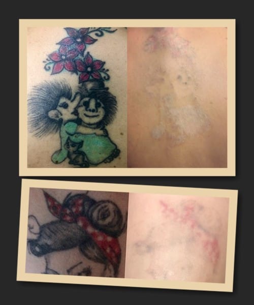 Видалити кольорове тату