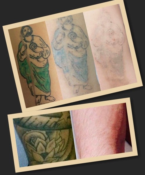 Повне видалення кольорової тату