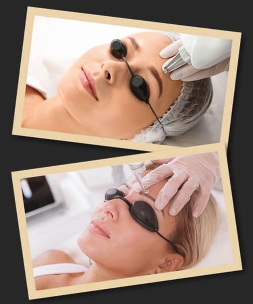 Видалення мікроблейдингу брів лазером