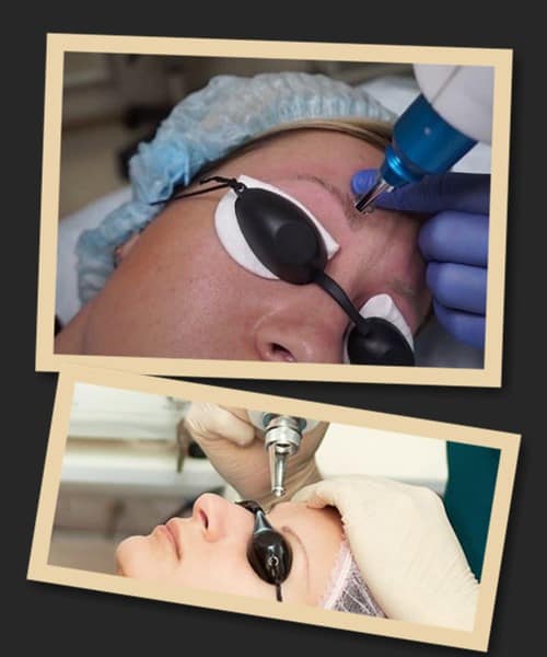 видалити мікроблейдинг