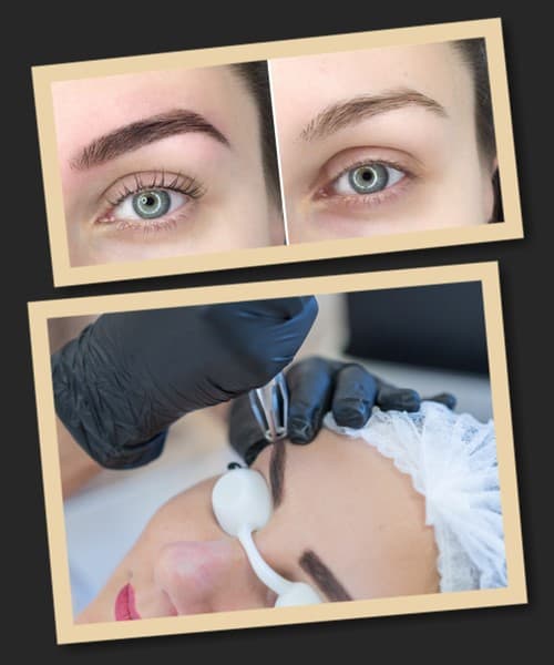 Видалення мікроблейдингу брів лазером