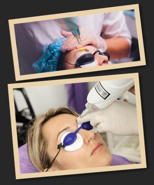 лазерний метод для видалення перманентного макіяжу брів