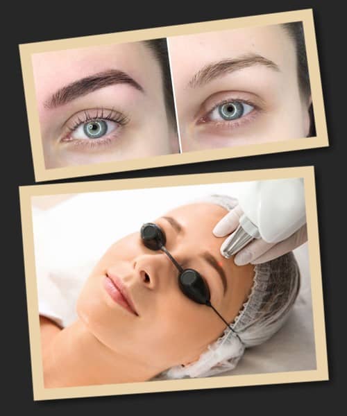 Видалення пудрових брів лазером