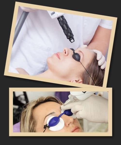 видалення пудрових брів лазером