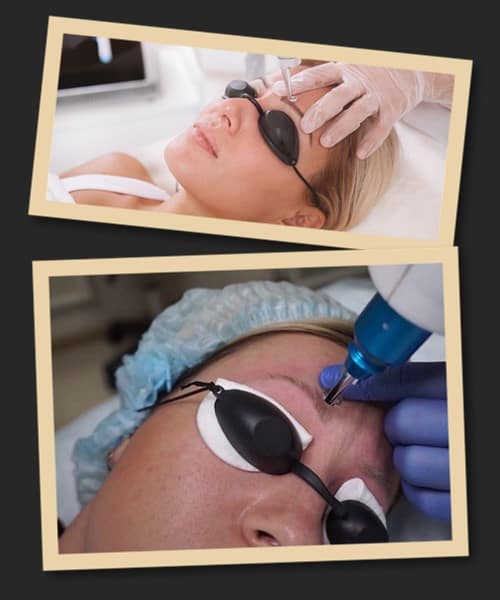 видалення пудрових брів лазером у Києві