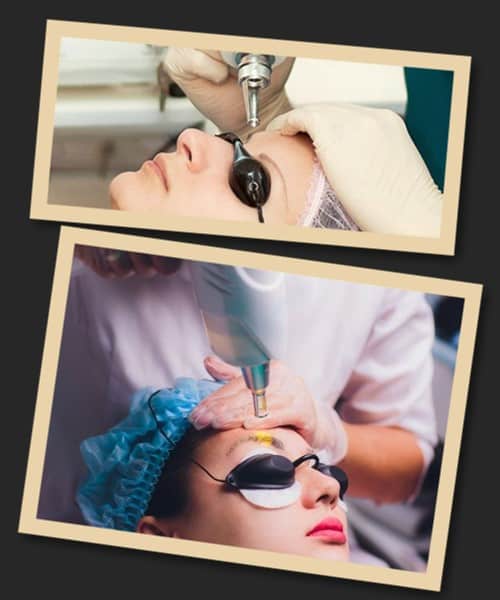 Лазерний метод видалення татуажу брів