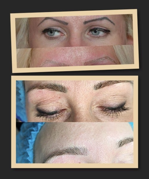 видалення ремувером брови